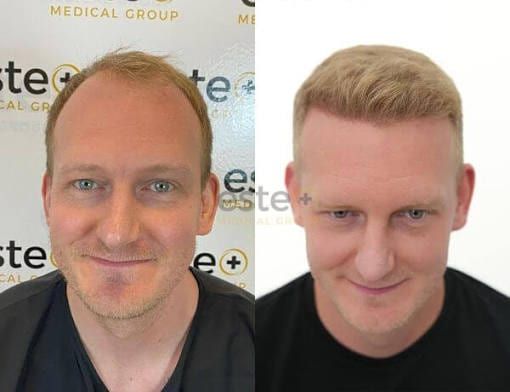 Men's before and after hair replacement system transformation